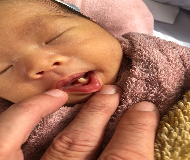 Trung tâm Y tế Tịnh Biên vừa phẩu thuật mổ lấy thai Bé gái 3 kg vừa chào đời đã có một chiếc Răng, được ví như